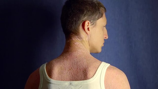 male patient with psoriasis is standing back to camera in a dark room, turning his head