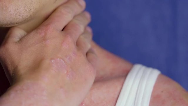 adult man is touching his neck with psoriasis patches, close-up of hands