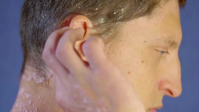 sick man is showing patches of skin with psoriasis on his head, standing in a profile