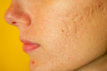 post-acne, scars and red festering pimples on the face of a young woman. concept of skin problems...