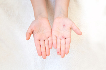 The hand of a child with chickenpox in her mother's hand. Blisters on the hand from chickenpox.