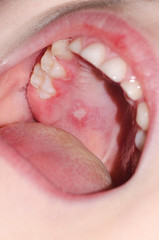 Fototapeta premium Stomatitis and herpes in the child's mouth close-up