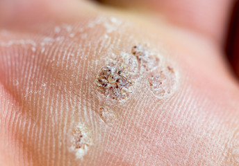 Fungus on the feet of a macro