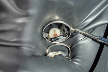 Obraz premium Restoration of the molar of a human tooth with filling material. The concept of aesthetic restorative dentistry in a dental clinic