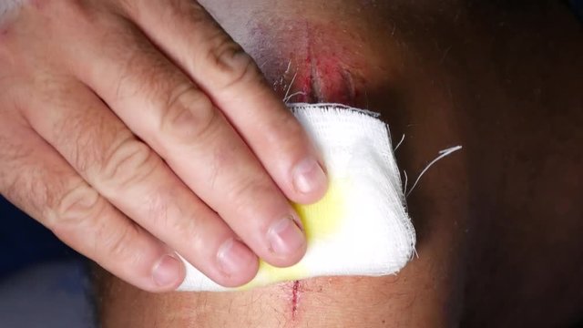 Doctor Applying a Medical Solution on Foot Wound 