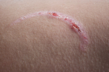 A burn scar that is partly healed