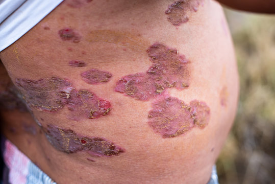 Psoriasis on human skin