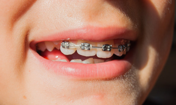 Fixed device on the teeth of a teenager