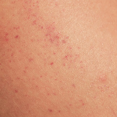 Fototapeta premium sick human skin texture covered with red allergic spots and irritations