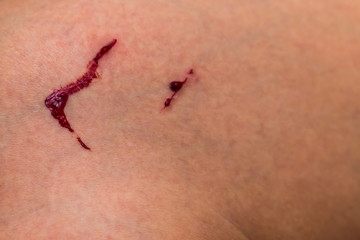 Bleeding wound in the leg