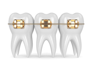 3d render of teeth with golden orthodontic braces