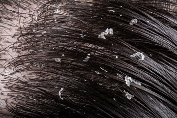 Dandruff on her dark hair