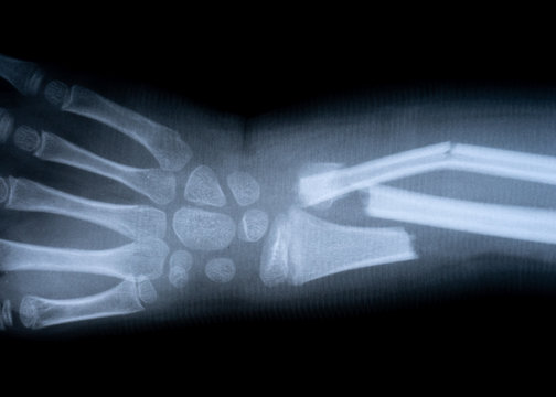 x-ray film skeleton human arm. health medical anatomy body concept