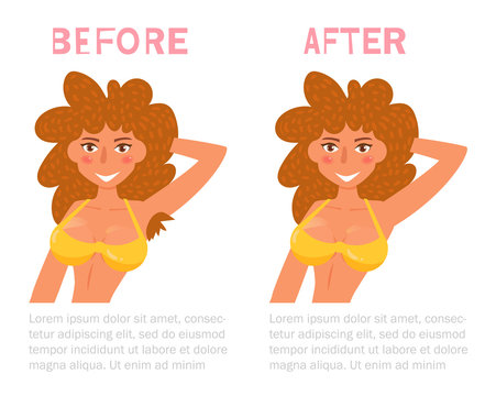 Armpit hair Before and after. Laser removal Vector. Cartoon. Isolated art on white background. Flat