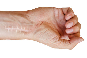 Scar with stitches on the wrist after surgery. Fracture of the bones of the hands in fist isolated...
