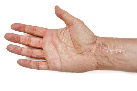 Scar with stitches on the wrist after surgery. Fracture of the bones of the hands isolated on white background