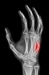 X-ray of fracture of metacarpal bone