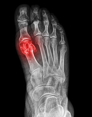 X-ray fracture of the first metatarsal bone