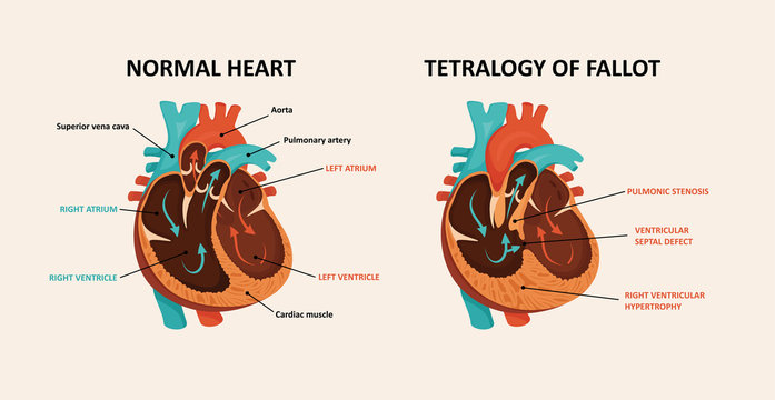 Congenital disease of the heart: Ventricular septal defect, Right ventricular hypertrophy, Pulmonic stenosis