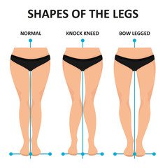 Types of curvatures human feet.