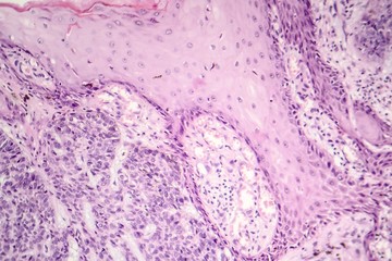 Basal cell carcinoma, skin cancer, light micrograph, photo under microscope