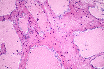 Hepatic cavernous hemangioma, a benign liver tumor, light micrograph, photo under microscope