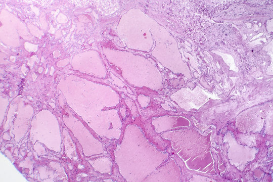 Hepatic cavernous hemangioma, a benign liver tumor, light micrograph, photo under microscope