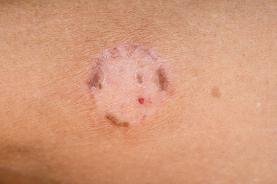 Herpes on the skin of man. Infectious skin disease_