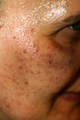 Fototapeta premium Pigmented spots on the face. Pigmentation on cheeks