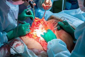 Surgical operation abdominoplasty. Close-up of the patient on the operating table, surgical removal...