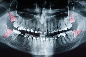 Growing Wisdom Teeth Pain On X-Ray - 223913308