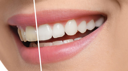 Smiling woman before and after teeth whitening procedure, closeup