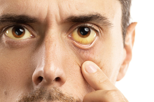 Yellowish eyes is sign of problems with liver, viral infection or other disease