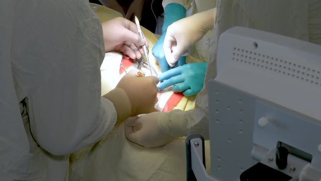 The surgeon during surgery removes the clot from the carotid artery. He is assisted by many specialists. Very complex manipulation.
