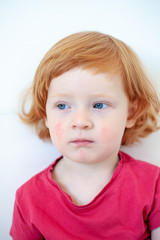 Allergies, atopic dermatitis on the face of a baby