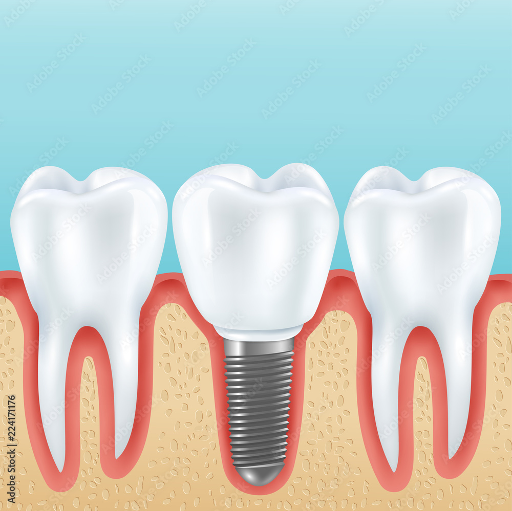 Sticker dental implant realistic illustration