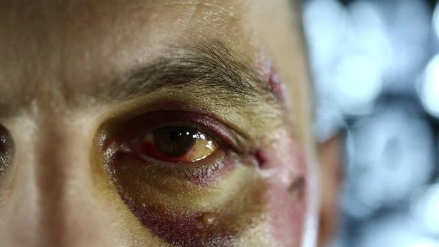 Trauma of face, hematoma of left eye, man with injury of face looks at the camera in medical center, roentgenogram of head at background. It is not a make-up, real trauma after falling off a bicycle