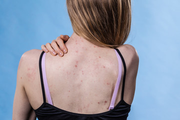 Fototapeta na wymiar Woman with skin problem acne on back