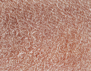 background texture of pink human skin covered with fine wrinkles and dry flaky particles