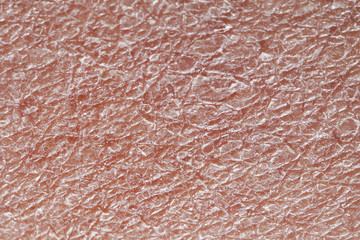 background texture of unhealthy human skin covered with deep wrinkles and dry flaky particles