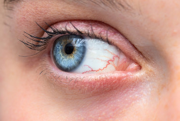 Fototapeta premium Eye with inflamed capillaries