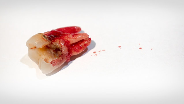 Extracted Bloody Tooth with Severe Dental Decay.