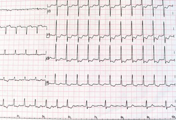 Top view of an electrocardiogram in printed paper form for health care and medical concept. EKG or...