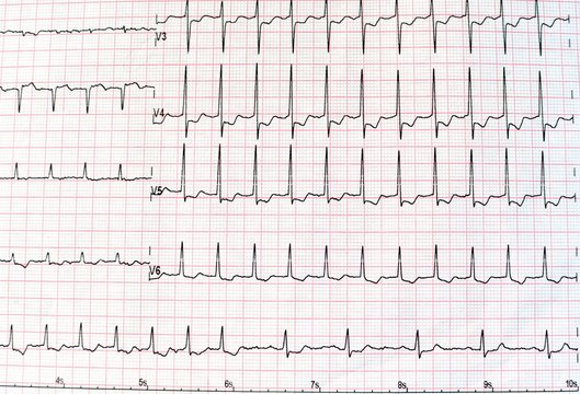 Top view of an electrocardiogram in printed paper form for health care and medical concept. EKG or ECG paper background
