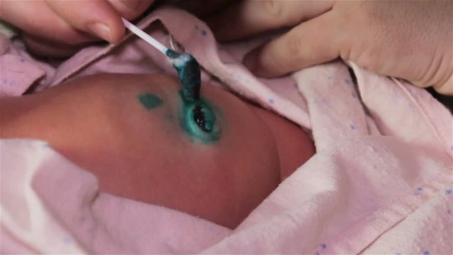 Cleaning Umbilical Cord,umbilical cord care in the newborn