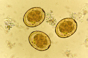 Eggs of Ascaris lumbricoides (roundworm) in stool, analyze by microscope
