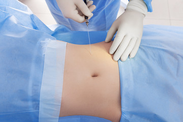 procedure for laser lipolysis of the abdominal region.