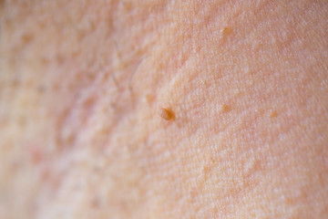 Closeup of fibroma on the skin of a young caucasian woman  - obrazy, fototapety, plakaty