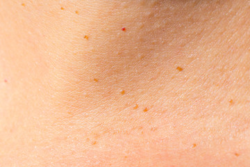 Closeup of several fibromas and birthmarks on the skin of a young caucasian woman  - obrazy, fototapety, plakaty