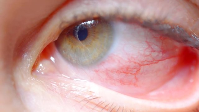 close up. woman eye with chemical burns of the cornea. burst capillaries